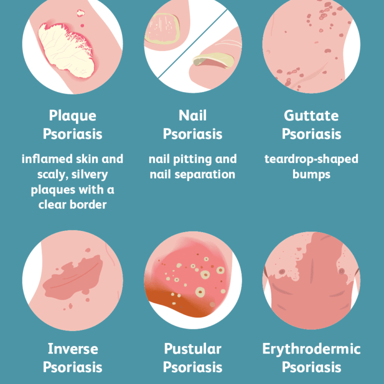 Types Of Psoriasis Verywellhealth 768x768 
